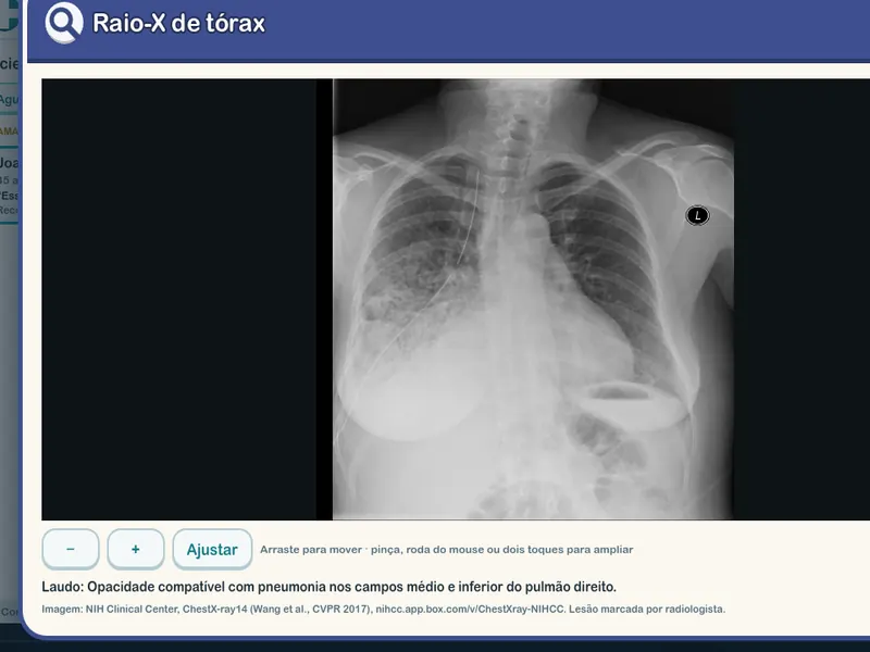 Raio-X de tórax com o laudo do radiologista